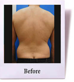 Back and flanks before body contouring