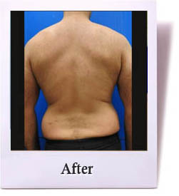 Back and flanks after body contouring