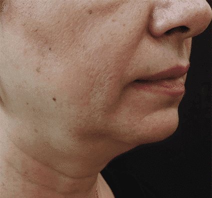 Jowl and jawline after Accent Prime