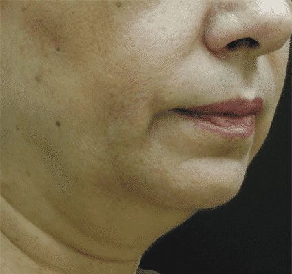Jowl and jawline before Accent Prime