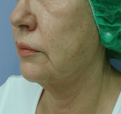 Lower face after Accent Prime skin tightening