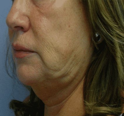 Lower face before Accent Prime skin tightening
