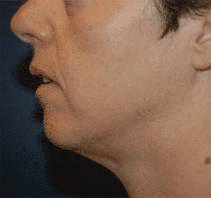 Jawline in profile after Accent Prime face contouring