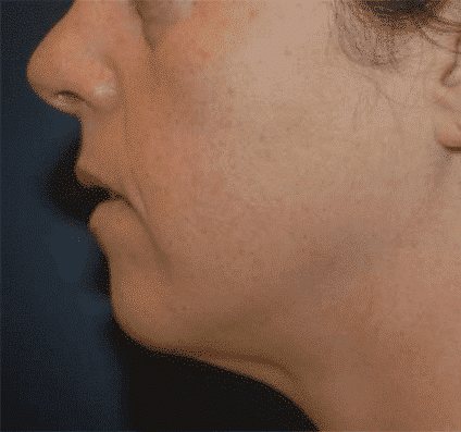 Jawline in profile before Accent Prime face contouring