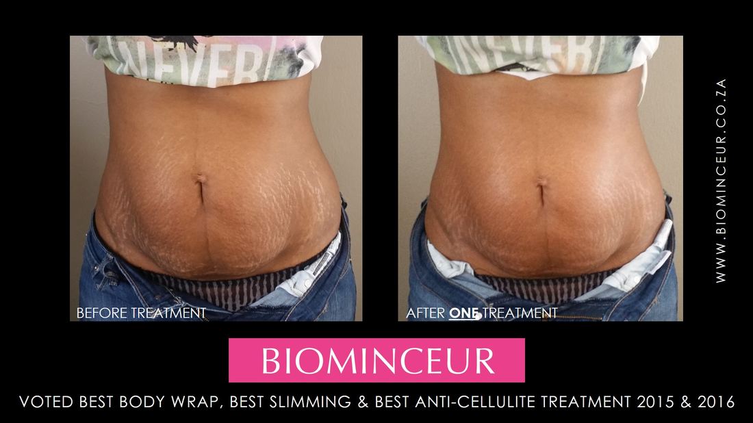 Before and after a BioMinceur body wrap, abdomen