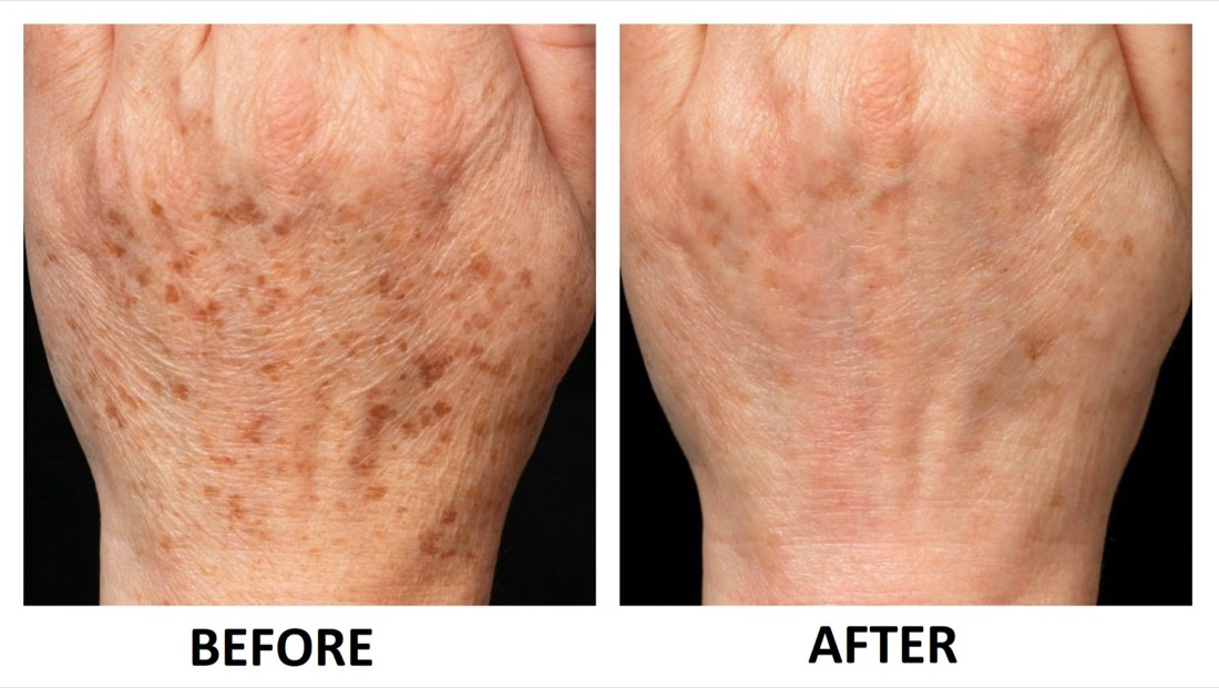 Before and after MicroPlasma resurfacing on the hands